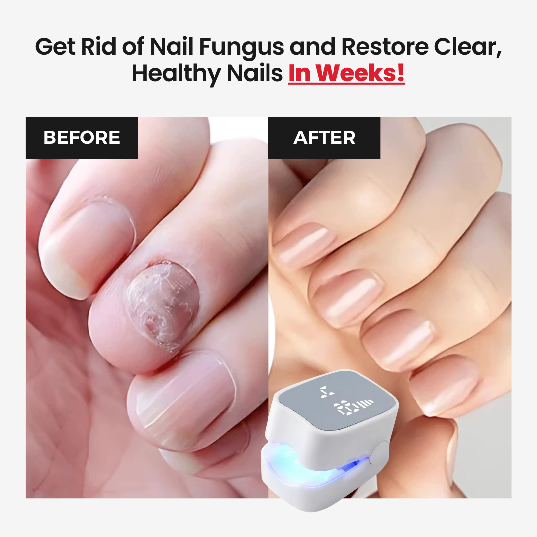 NailCure Pro™ - At-Home Nail Fungus Laser Device